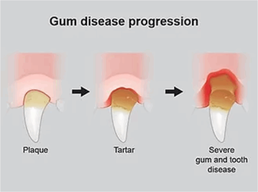 Diagram showing the stages of gum disease